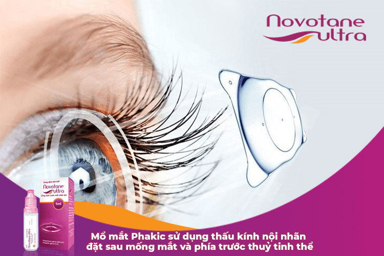 Mổ mắt Phakic sử dụng thấu kính nội nhãn đặt sau mống mắt và phía trước thuỷ tinh thể