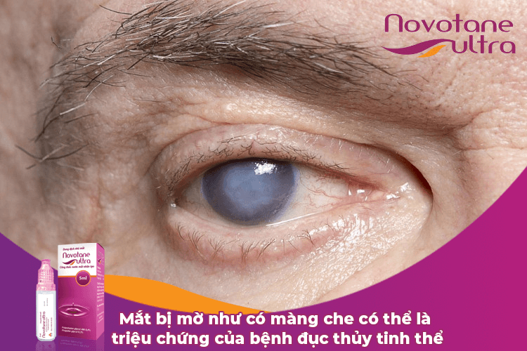 Mắt bị mờ như có màng che có thể là triệu chứng của bệnh đục thủy tinh thể